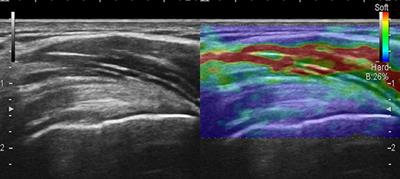 Sonoelastography of the Shoulder: A Narrative Review